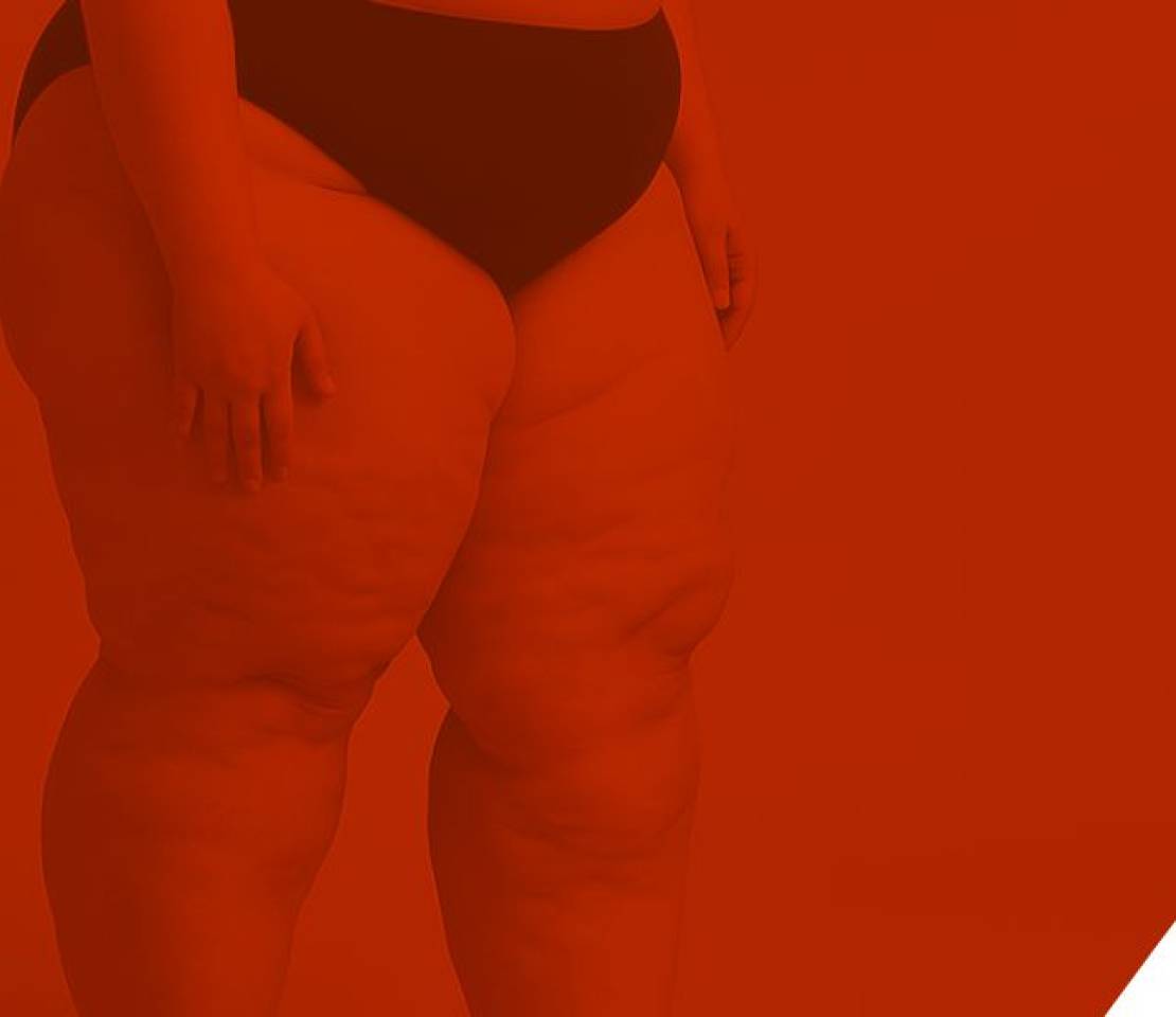 Por que o lipedema afeta quase só mulheres? Descubra a ligação com os hormônios!