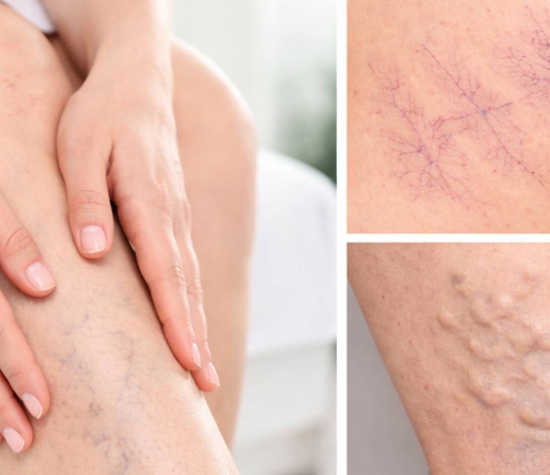 Veias aparentes são varizes? Entenda as diferenças
